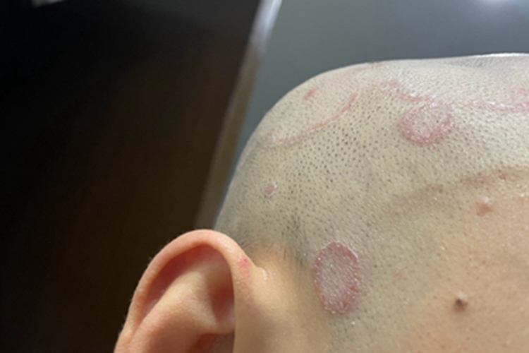 脓癣头皮红肿化脓图 脓癣头皮红肿化脓图