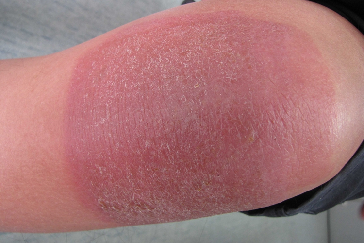 环氧树脂过敏红斑图