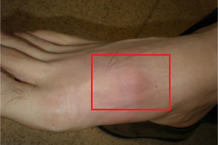 结节性多动脉炎脚部小红疙瘩图
