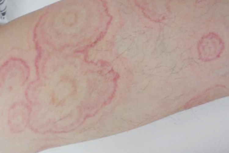 匍行性回状红斑图