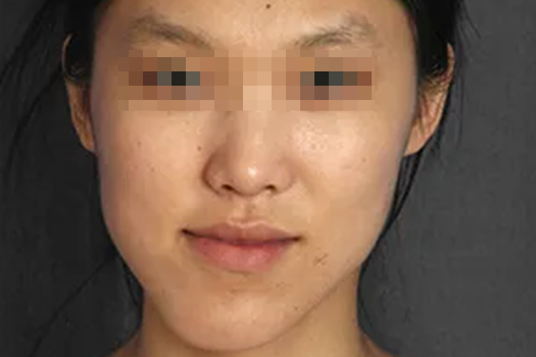 牙齿咬合导致脸歪图