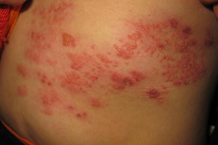 带状疱疹初期图 带状疱疹初期图