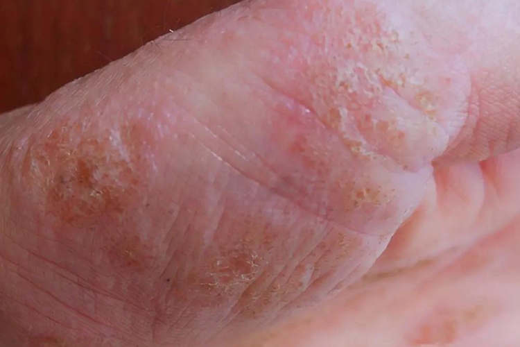 手部湿疹图