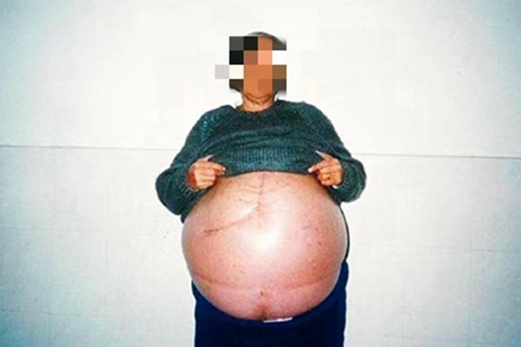 血吸虫病腹部膨隆图