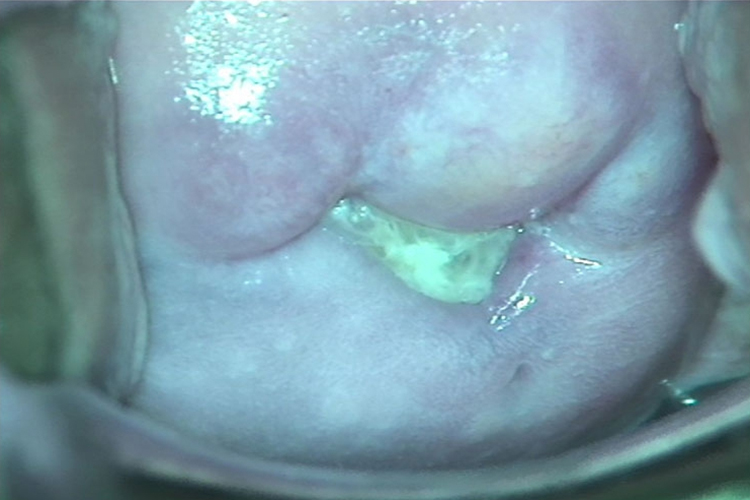 细菌性阴道病图