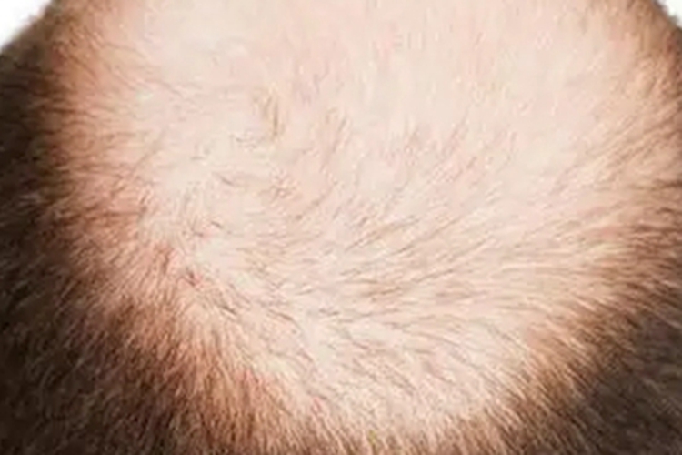 拔毛癖头发顶部全秃了图 拔毛癖头发顶部全秃了图