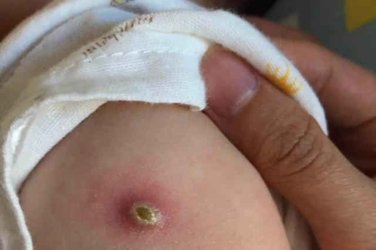 卡介苗接种后结痂图