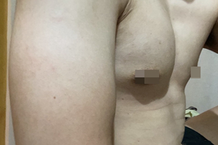 男性乳房肥大症隆起图 男性乳房肥大症隆起图