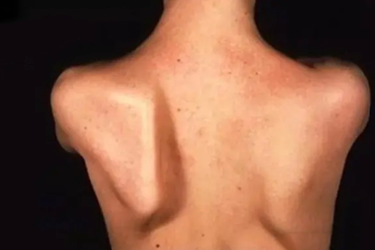 翼状肩图 翼状肩图