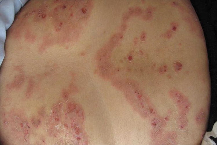 天疱疮腹部红斑图