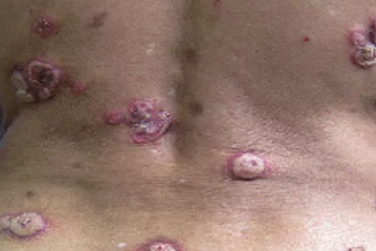 男性结节性梅毒疹背部症状图