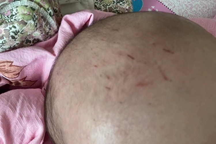 慢性湿疹头顶有红色抓痕图