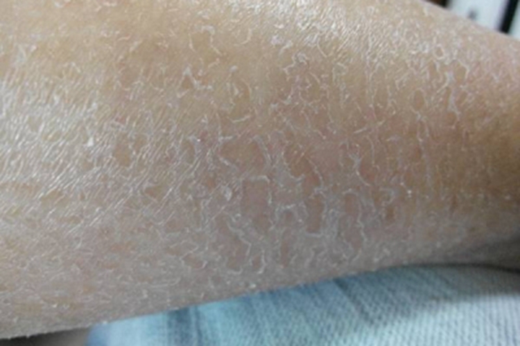 皮肤干燥症小腿干燥脱屑图
