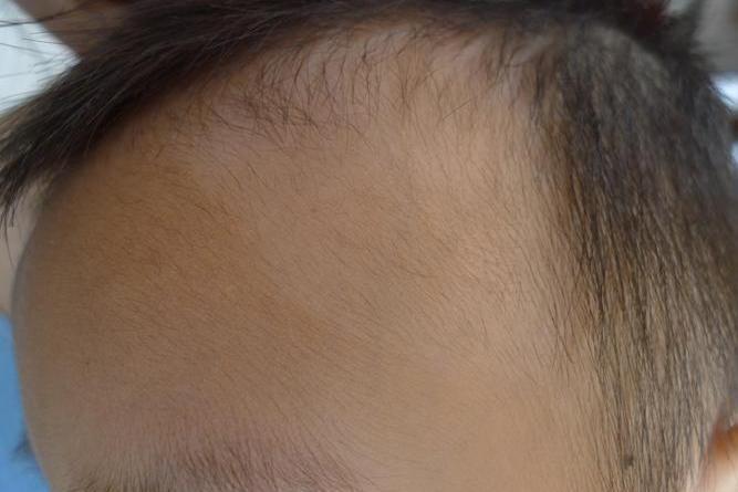 婴儿额头白癜风图 婴儿额头白癜风图