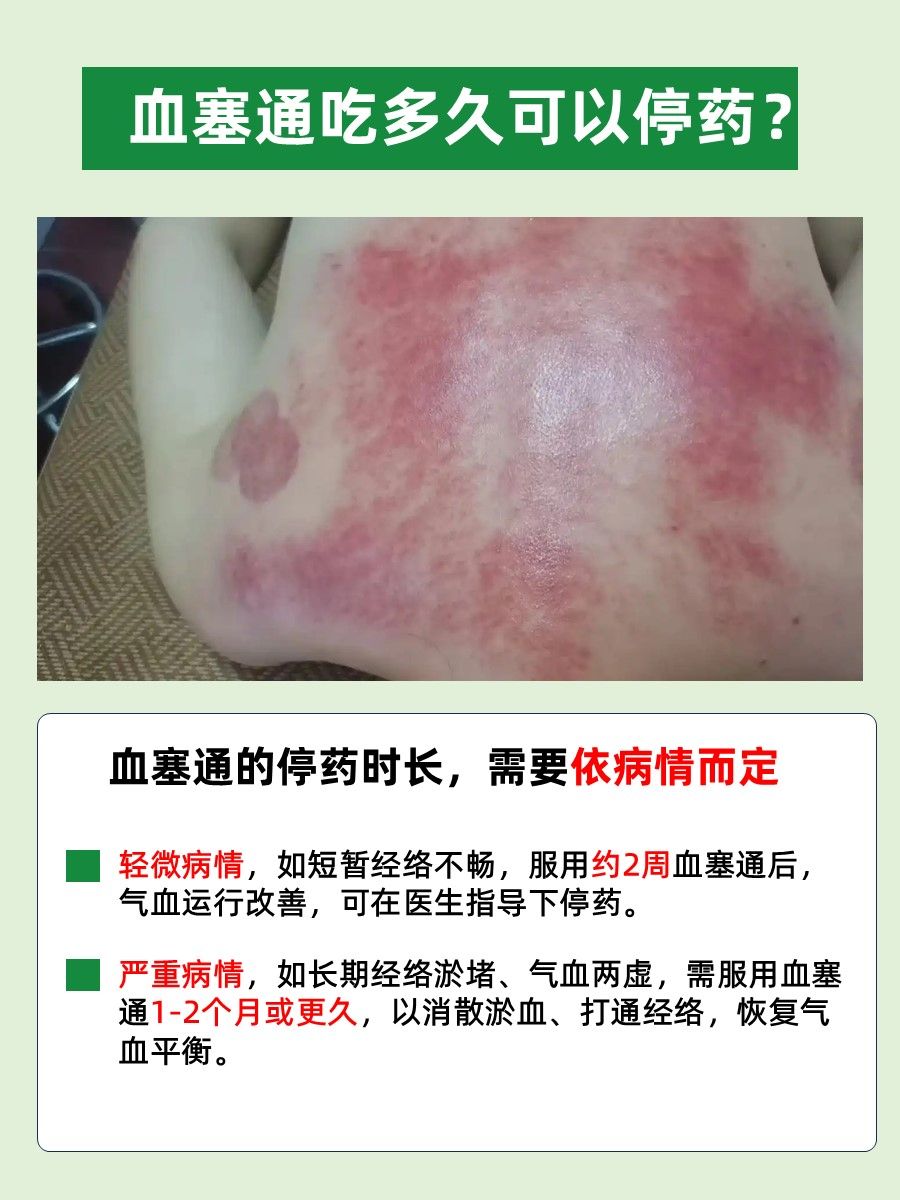 血塞通服用疗程详解：停药时间不再难抉择