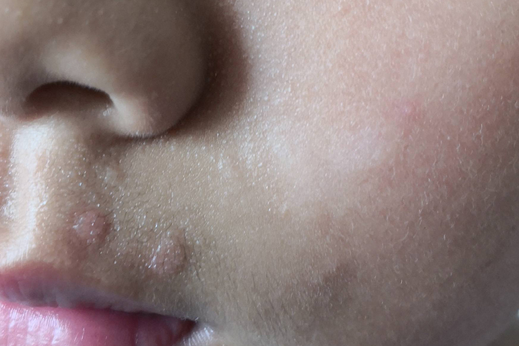 颜面部扁平疣图