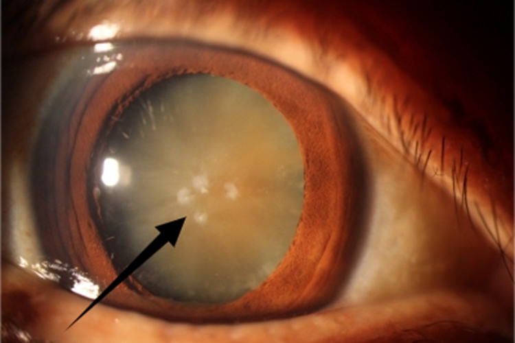 老年性白内障眼球黄斑图 老年性白内障眼球黄斑图