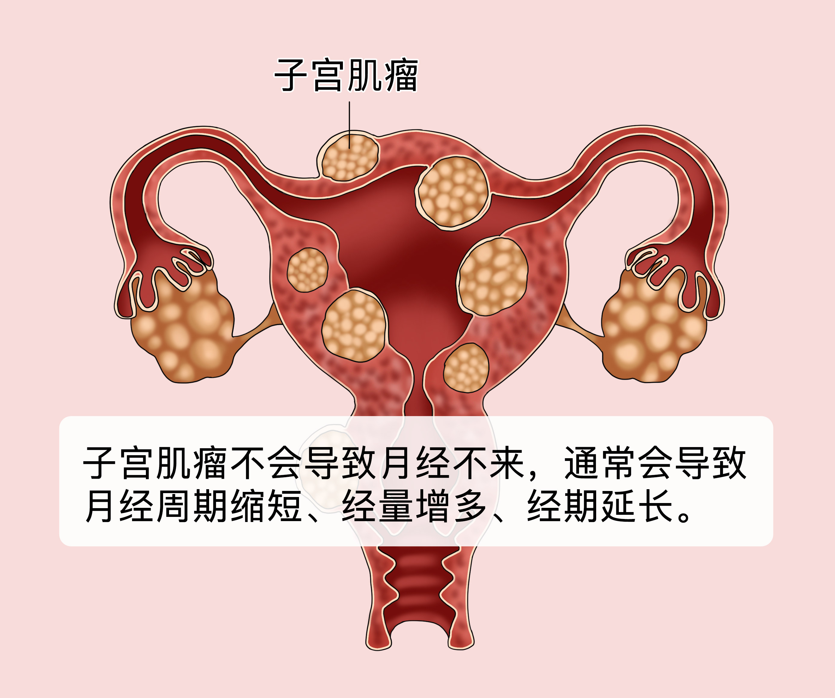 慢性子宫内膜炎的症状有哪些？5个原因可致子宫内膜炎-京东健康