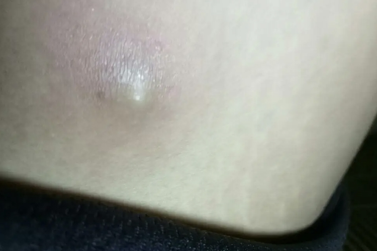 女性大腿根部皮脂腺囊肿图 女性大腿根部皮脂腺囊肿图