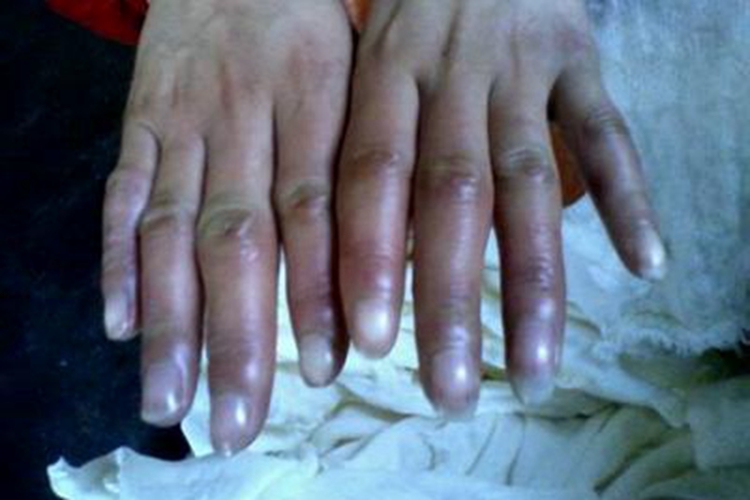 冻疮手指症状图