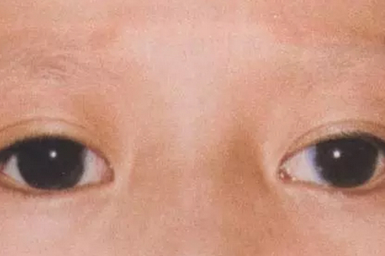 毛玻璃样混浊图