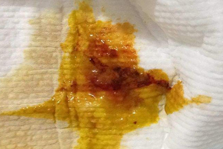 肠癌大便黏液带血图