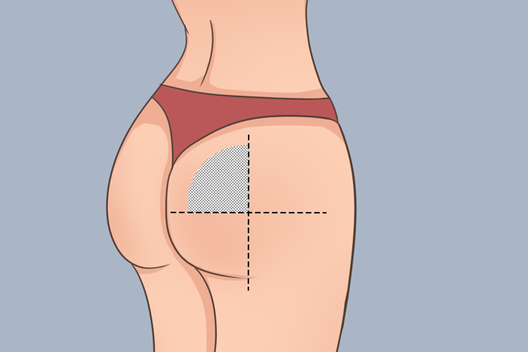 肌内注射臀大肌位置图 肌内注射臀大肌位置图