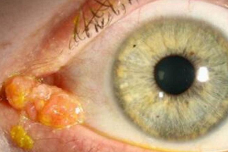 结膜乳头状瘤长瘤图