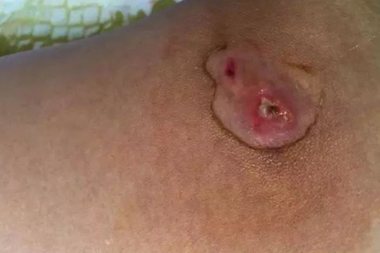 被咬处皮肤肿胀图