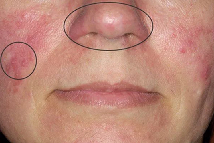 丘疹脓疱型酒糟鼻鼻头有红斑图