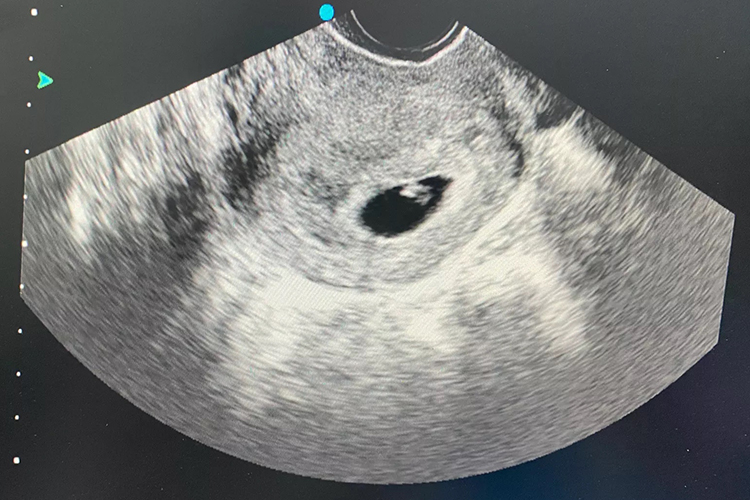 水滴型孕囊超声影像图