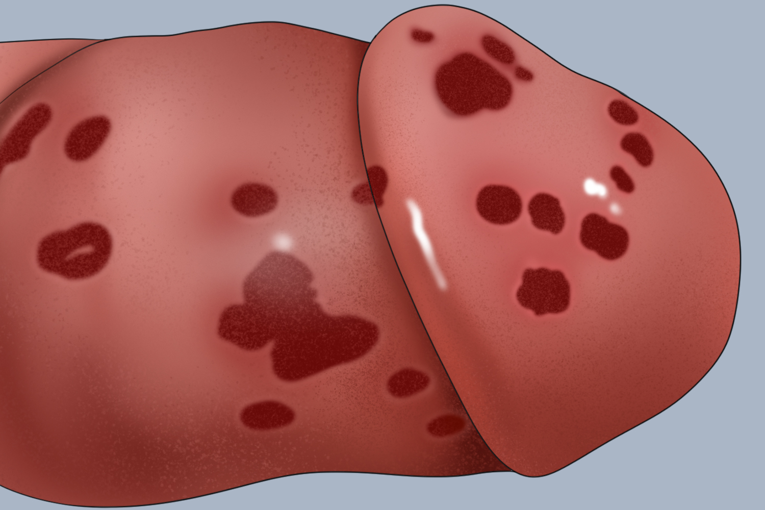 环状溃烂性龟头炎环状红斑