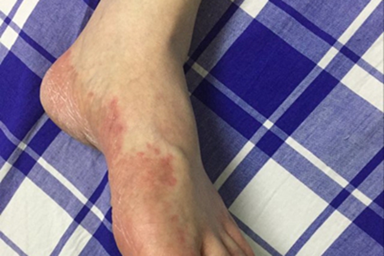 系统性红斑狼疮脚部红斑图