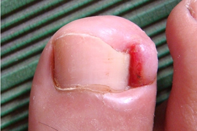 念珠菌性甲沟炎脚趾图