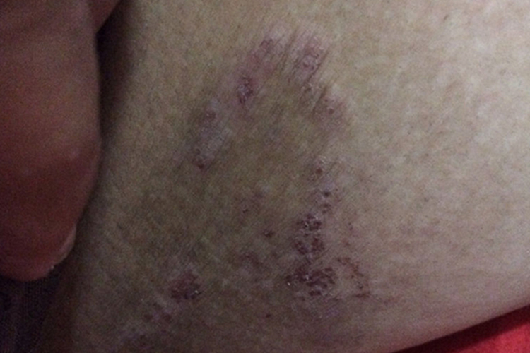 大腿内侧黑棘皮病图