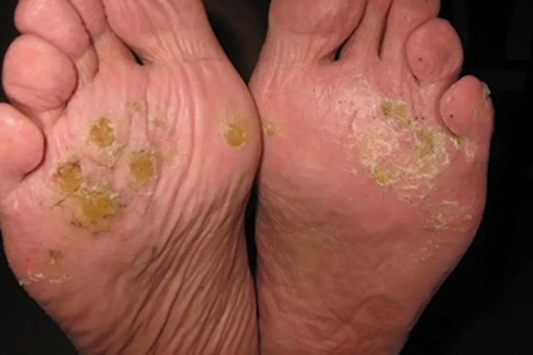 点状掌跖角皮症脚底皮肤粗糙图
