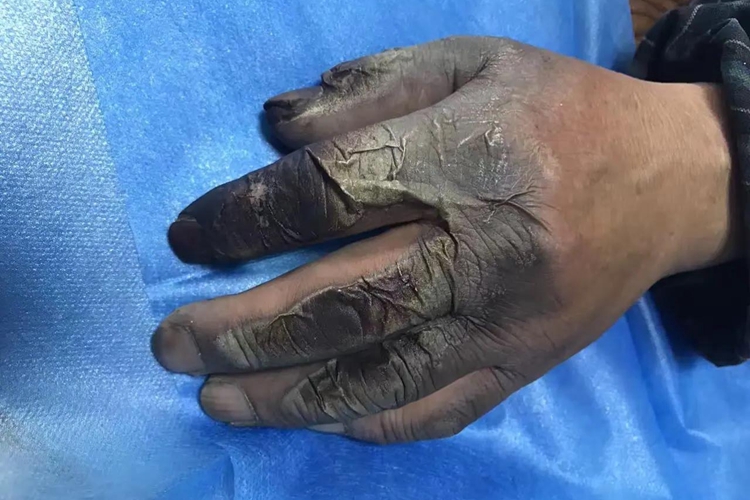 高压电烧伤碳化图