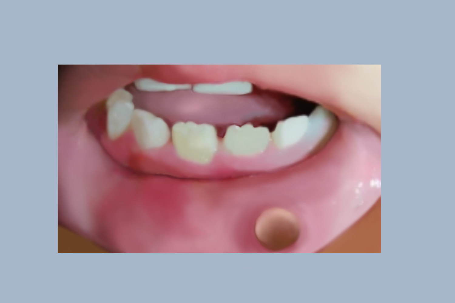 嘴唇里乳头状瘤无蒂图 嘴唇里乳头状瘤无蒂图