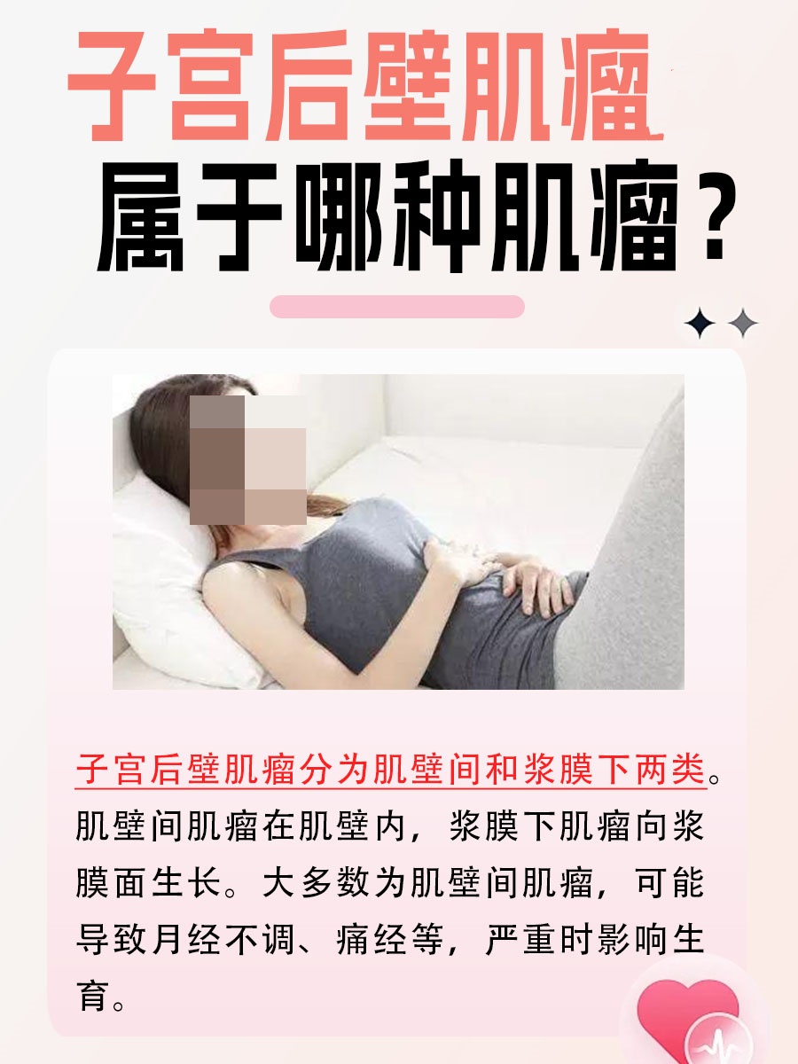 解析：子宫后壁肌瘤属于哪种肌瘤