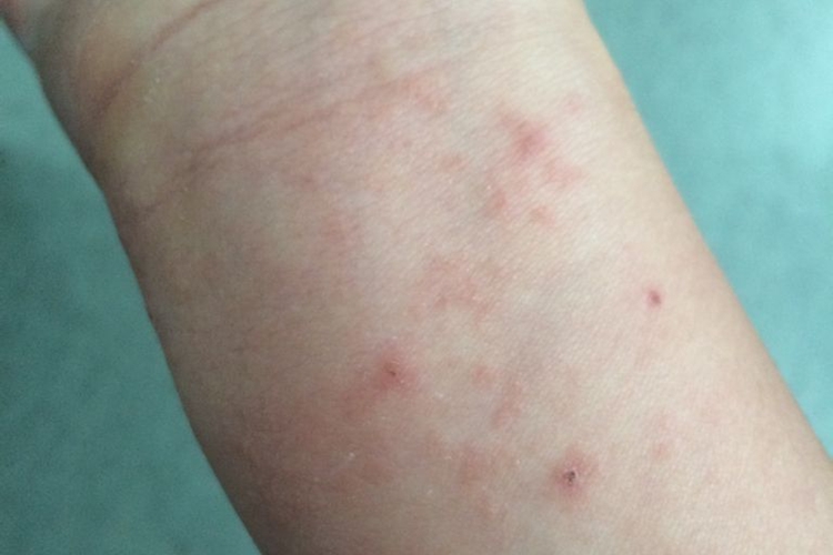 湿疹手臂内侧长红疹图