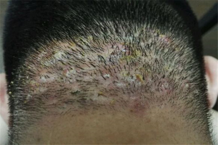 头生疮黄痂图