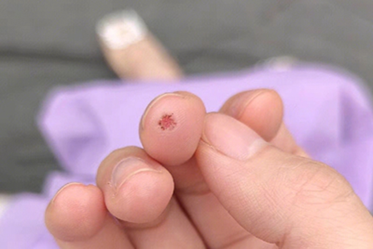 寻常疣手指尖小坑图