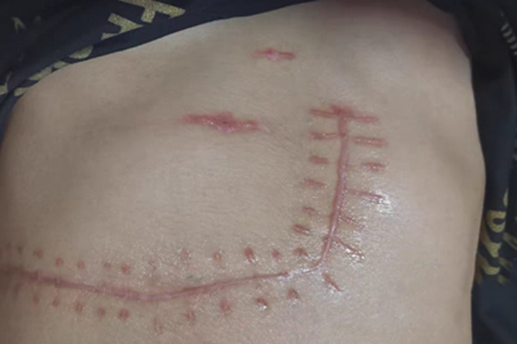 瘢痕疙瘩腹部有突出的瘢痕图