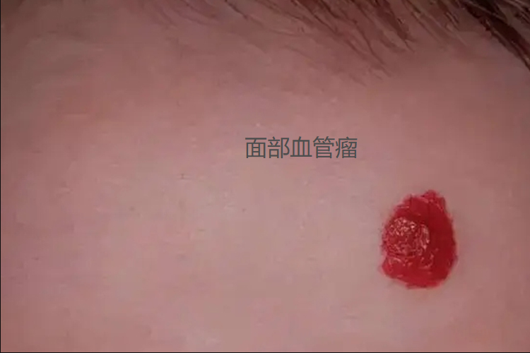 面部鲜红色血管瘤图