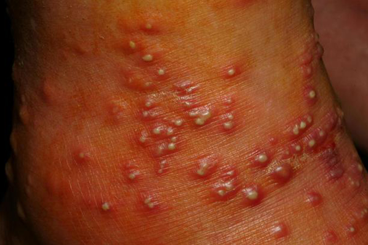 被火蚁咬了红肿图