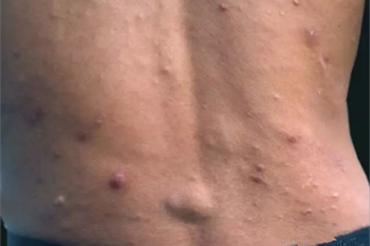 瘤型麻风背部结节图 瘤型麻风背部结节图