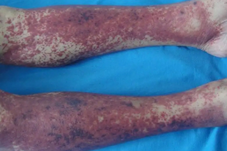 异常蛋白血症紫癜小腿紫斑图