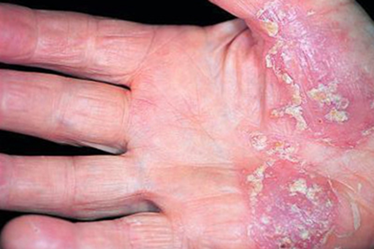 急性湿疹手掌结痂图