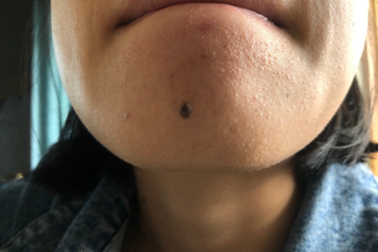 复合痣下巴症状图