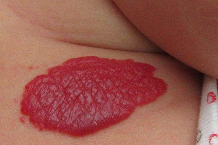 婴儿单纯性血管瘤图